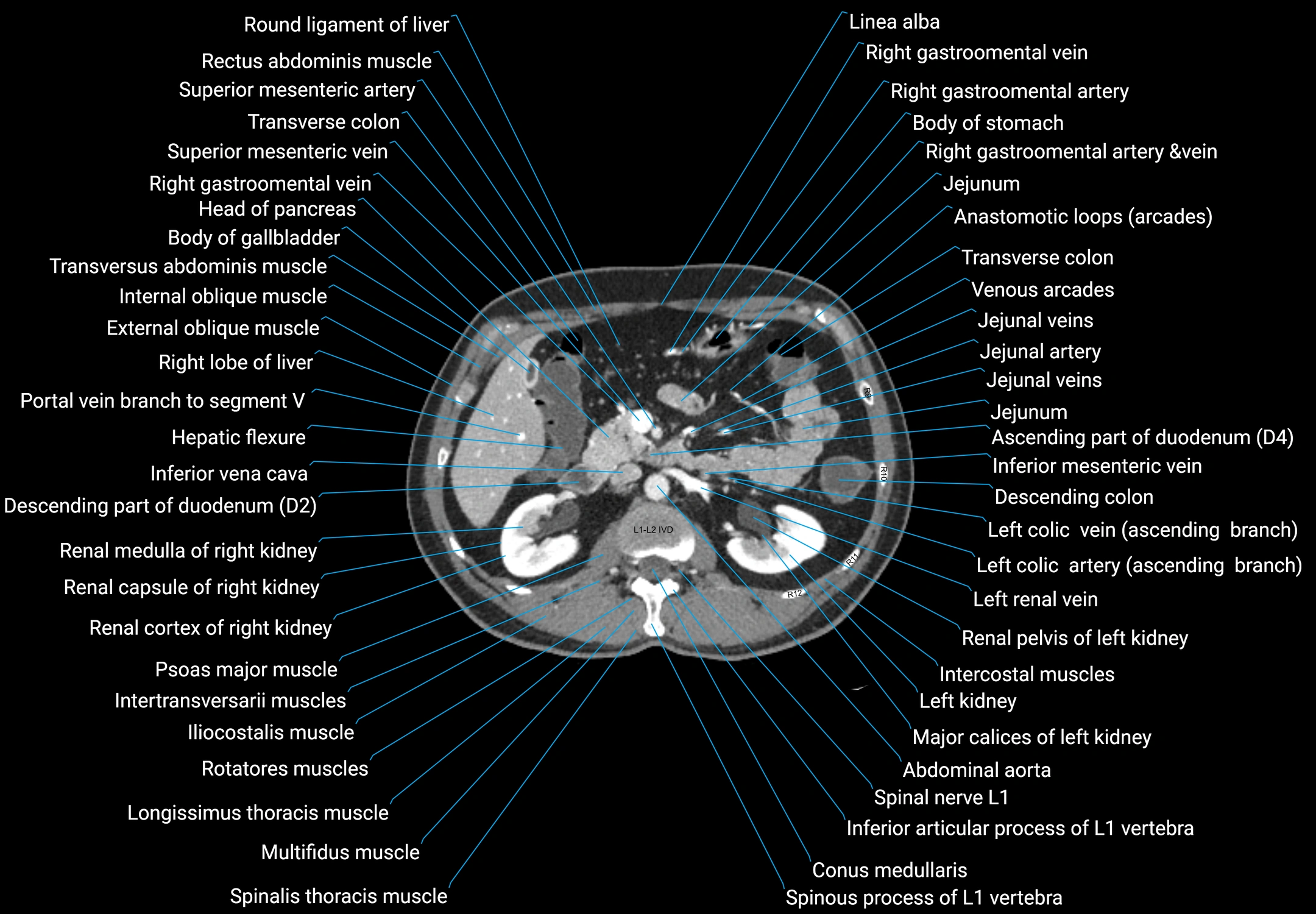 CT male pelvis axial cross sectional anatomy labelled radiology image -00065.webp